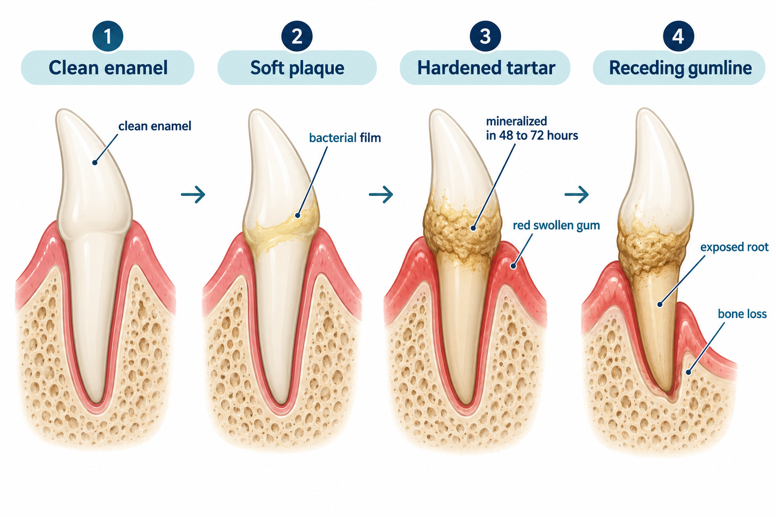What happens if you never brush your dog's teeth?